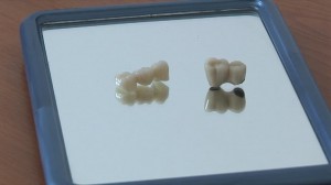 Metallkeramik Krone vs. Zirkonkrone in der Zahnarztpraxis Ungarn